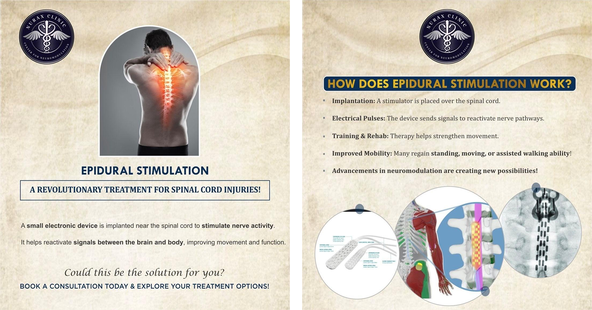 Epidural stimulation device and electrode placement